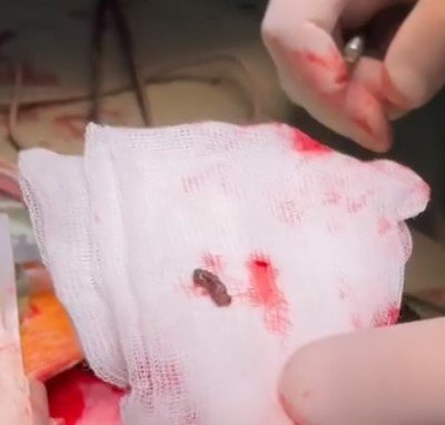 З серця 4-річної дівчинки, яка потрапила під обстріл в Херсоні, дістали уламок міни