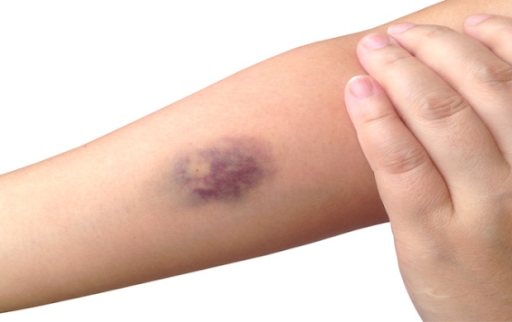 Гематоми: причини, лікування та профілактика