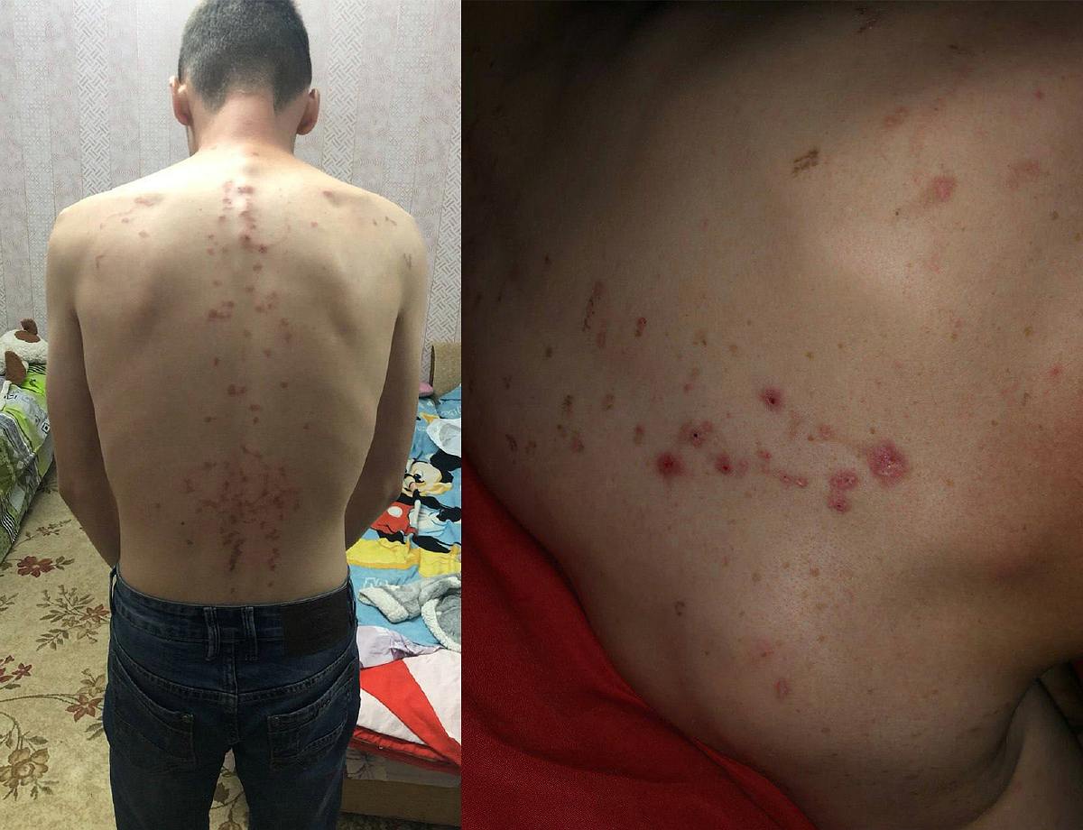 Результати катувань росіянами